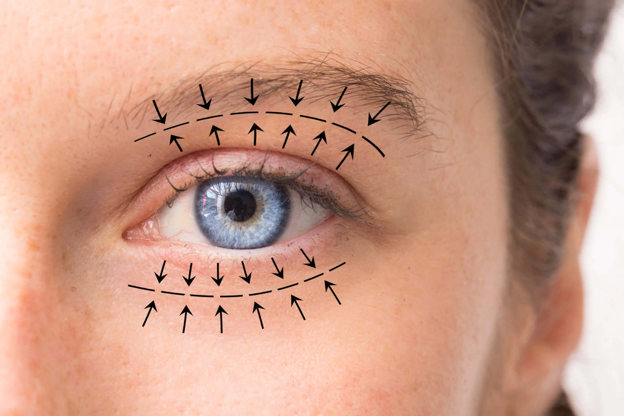 Close-up of an eye marked with eyelid surgery guide lines