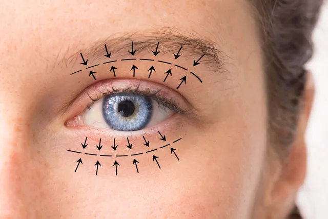 Close-up of an eye marked with eyelid surgery guide lines