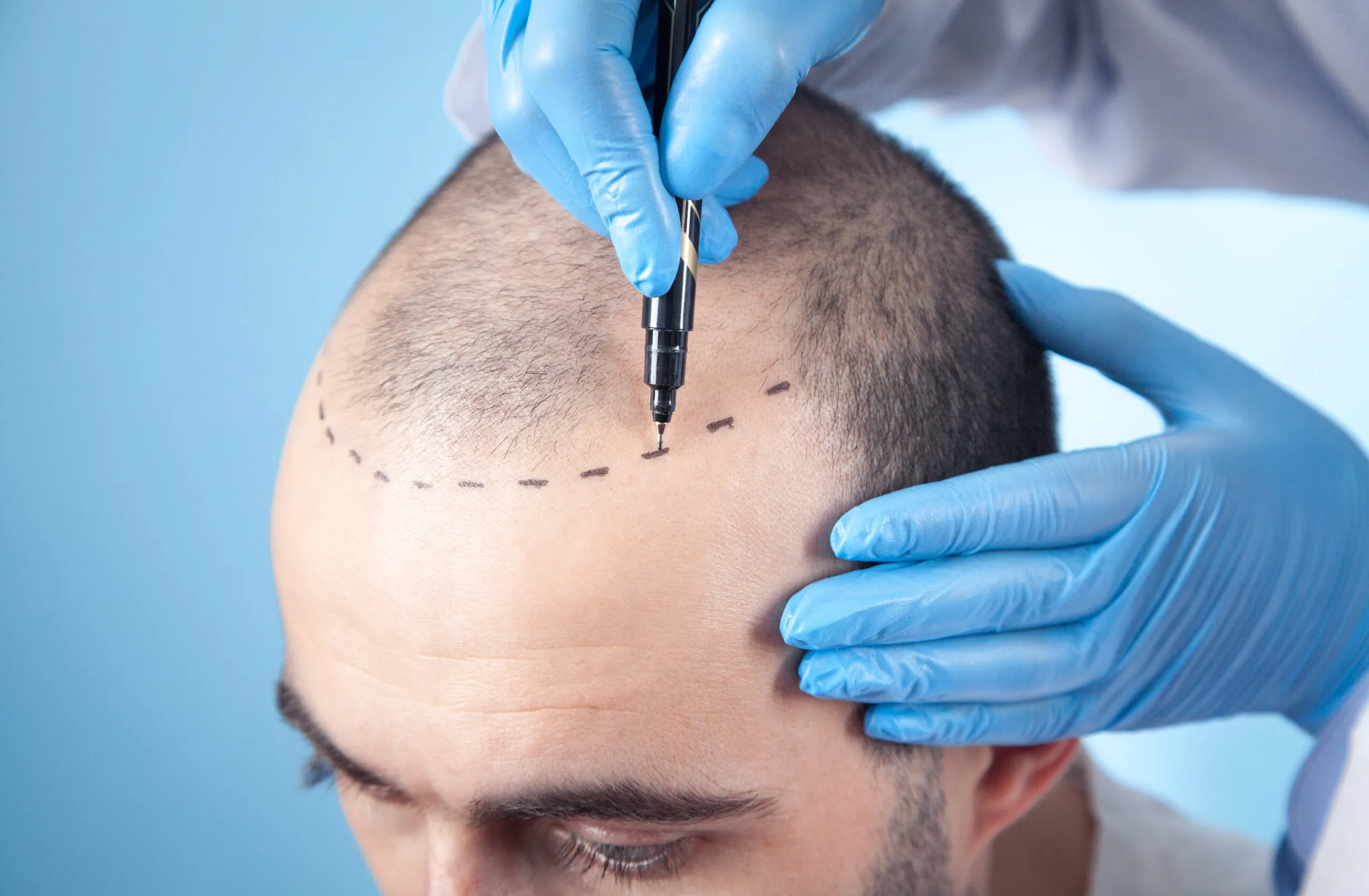 Surgeon marking the hairline before a hair transplant procedure